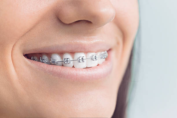 Dental Inlays and Onlays in Lakeview, OH